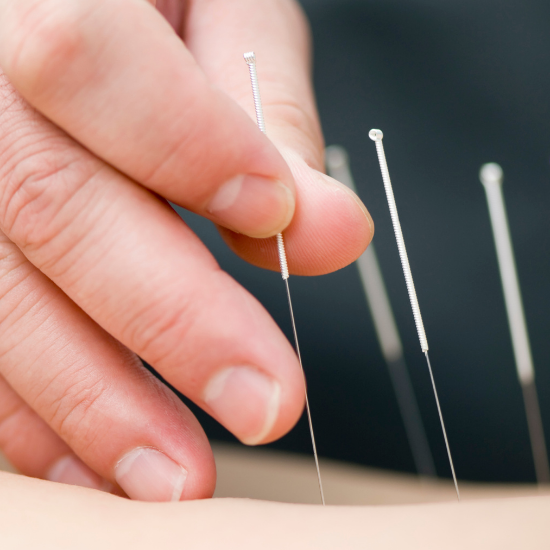 Acupuncture